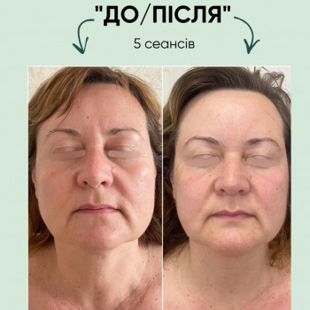 Масаж обличчя
                    Салон краси Vitality Ірпінь