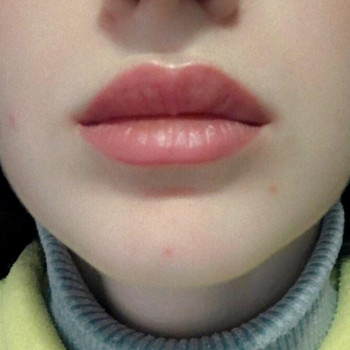 Загоєні губи