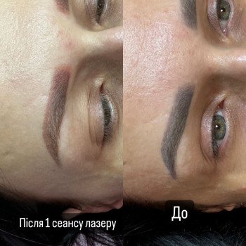 Видалення тату
                    Мастер перманентного макияжа Марьяна Киев