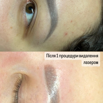 Видалення тату
                    Мастер перманентного макияжа Марьяна Киев