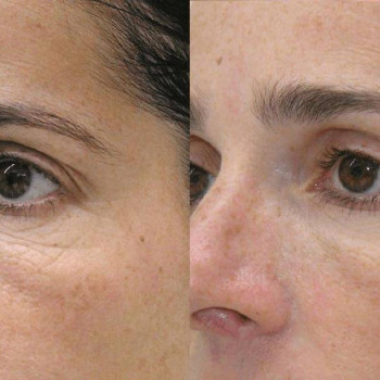 До та Після курсу біоревіталізації