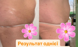 Ручная липопластика Масажист Ольга Одеса