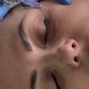 Біоревіталізація переорбітальної ділянки