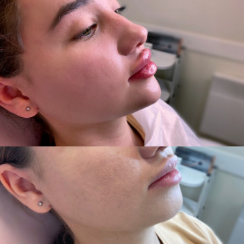 Контурная пластика подбородка