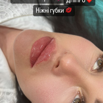 Збільшення губ #