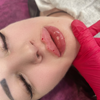 Збільшення губ #