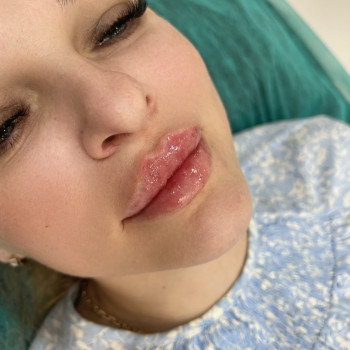 Збільшення губ #