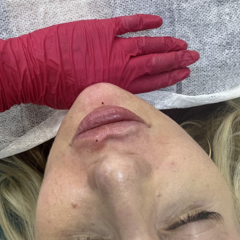 Корекція підборіддя #