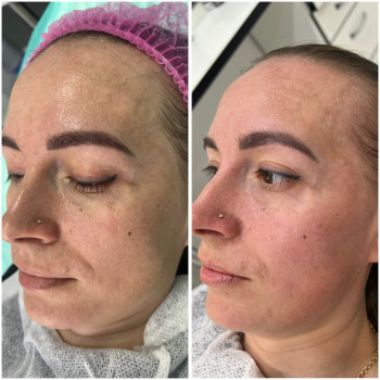 Курс пілінгів та біоревіталізаціі #