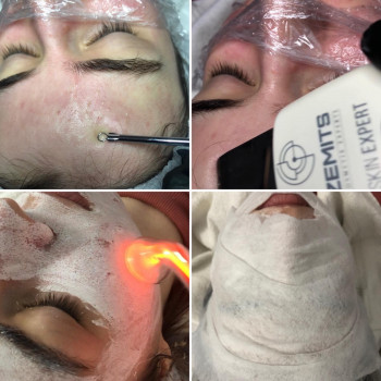 Комбинированная чистка лица
                    Косметолог Ирина Одеса