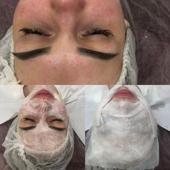 Комбинированная чистка лица
                    Косметолог Ирина Одеса