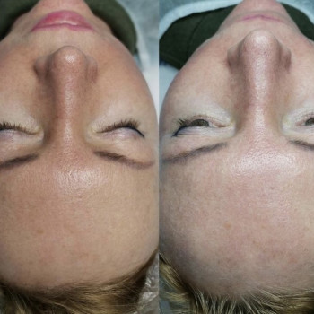 Миндальный пилинг! Осветление, сужение пор, увлажнение!🍀