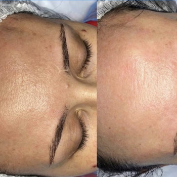 Мультиактивный пилинг! Уменьшение гиперкератоза( увеличение эпидермиса), осветление, выравнивание ре...