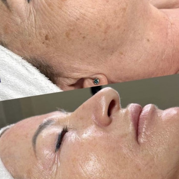 Омоложение с помощью химических пилингов в составе ТСА)🍀🍀🍀