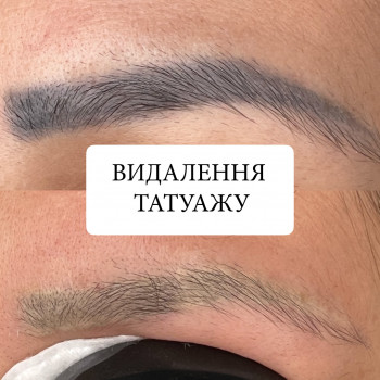 Результат видалення старого татуажу лазером