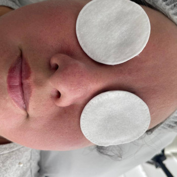 Комбінована чистка обличчя
                    Косметолог  Київ