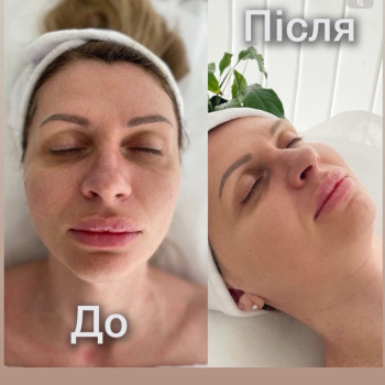 Ферментотерапія
                    Косметолог  Киев