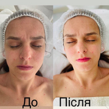 Ферментотерапія
                    Косметолог  Киев