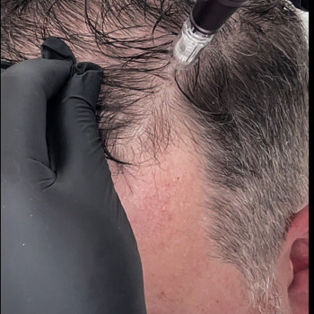 Мезотерапія шкіри голови
                    Косметолог  Киев