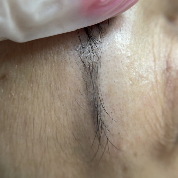 Зроблена одна процедура видалення ремувером, вийшов сірий відтінок