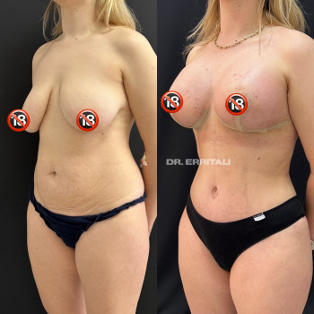 Маммопластика (увеличение груди)
                    Пластический хирург Абдель Харьков