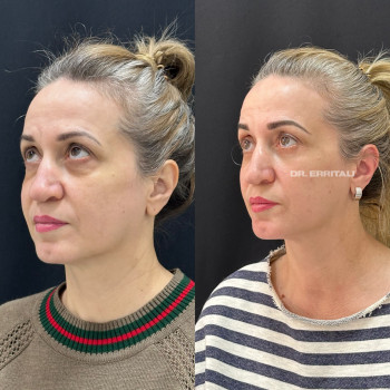 Лазерная блефаропластика
                    Пластический хирург Абдель Харьков