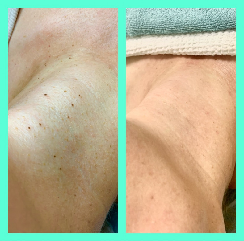 Удаление папиллом жидким азотом, фото - Мастер по пирсингу Татьяна Ананьева