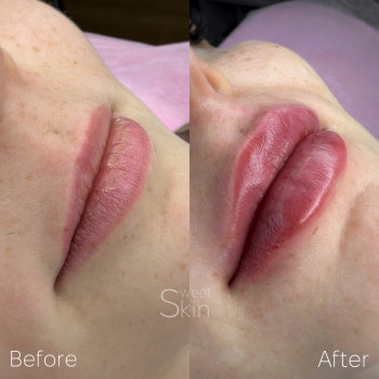 Контурна пластика губ Stylage
                    Салон краси Sweet Skin Київ