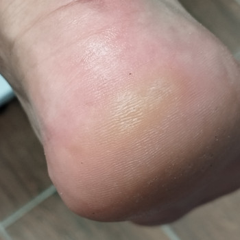 Чистка п'яти
                    Подолог Алена Горішні Плавні