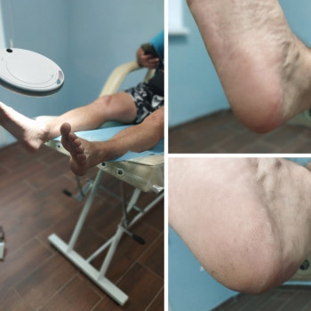 Гигиенический педикюр без покрытия
                    Подолог Алена Горишние Плавни