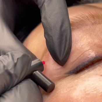 Електроепіляція
                    Косметологічний центр Laser Impulse Тернопіль