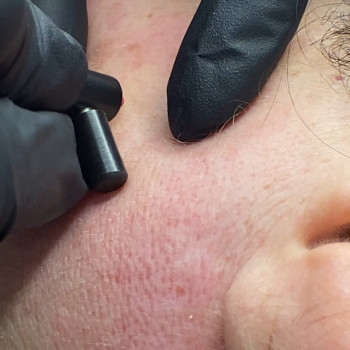 Електроепіляція
                    Косметологічний центр Laser Impulse Тернопіль