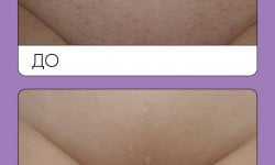 Лазерна епіляція Лешмейкер Ксения Львов