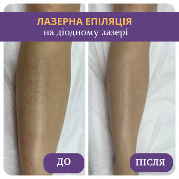 Лазерна епіляція
                    Лешмейкер Ксения Львов