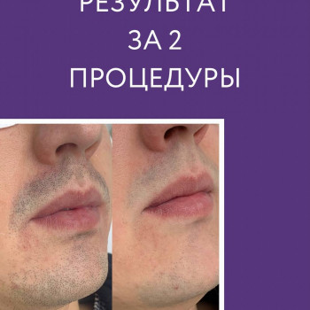 Лазерна епіляція
                    Лешмейкер Ксения Львов