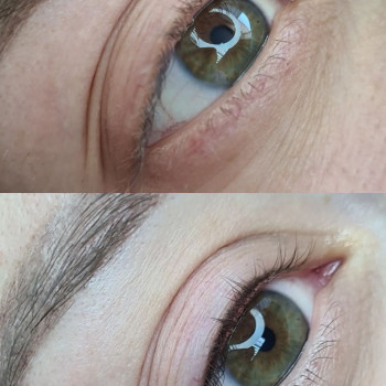 Результат міжвійки До та Після процедури