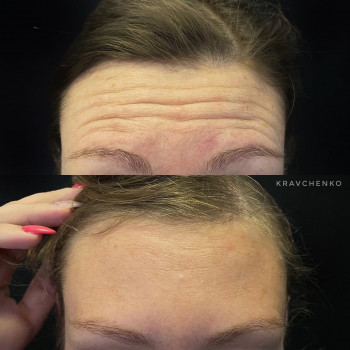 Ботокс в лоб. Ботокс чола. Ботулінотерапія

До та після
   