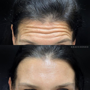 Ботокс в лоб. Ботокс чола. Ботулінотерапія

До та після
   