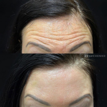 Ботокс в лоб. Ботокс чола. Ботулінотерапія

До та після
   