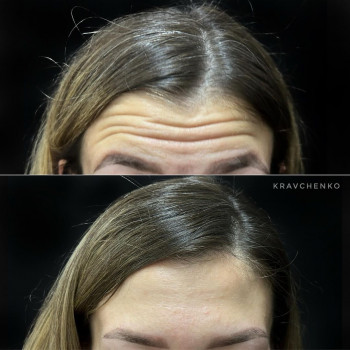 Ботокс в лоб. Ботокс чола. Ботулінотерапія

До та після
   