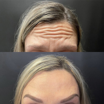 Ботулінотерапія