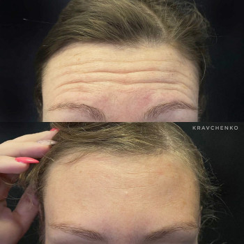 Ботулінотерапія