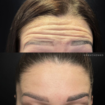 Ботулінотерапія