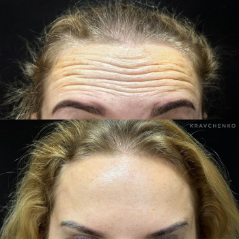 Ботулінотерапія