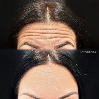 Ботулінотерапія