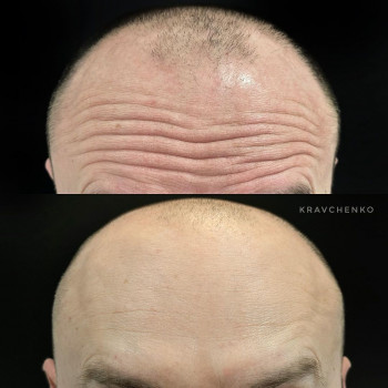 Ботулінотерапія