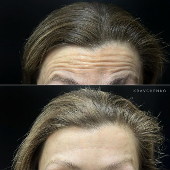 Ботулінотерапія