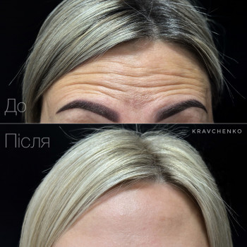 Ботулінотерапія лоба