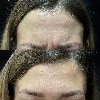 Ботулінотерапія міжбрів'я