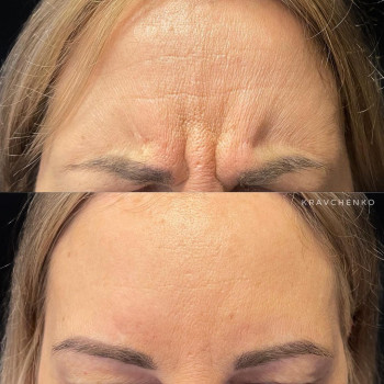 Ботулінотерапія міжбрів'я